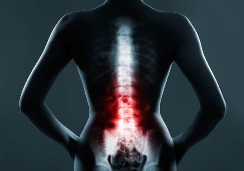 Lesiones comunes de la columna vertebral y opciones de tratamiento