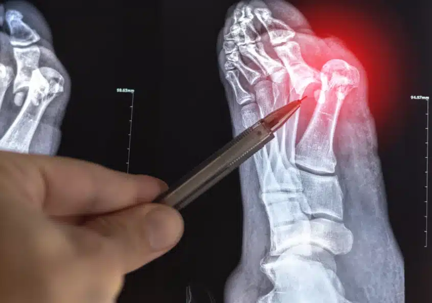 Radiografía del pie en la que se aprecia un juanete (hallux valgus), con la deformidad de la articulación del dedo gordo resaltada en rojo y un lápiz que señala la zona afectada para facilitar el diagnóstico médico.