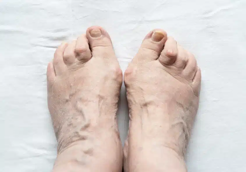 Vista superior de los pies en la que se observan dedos en martillo, con los dedos curvados y doblados por la articulación media.